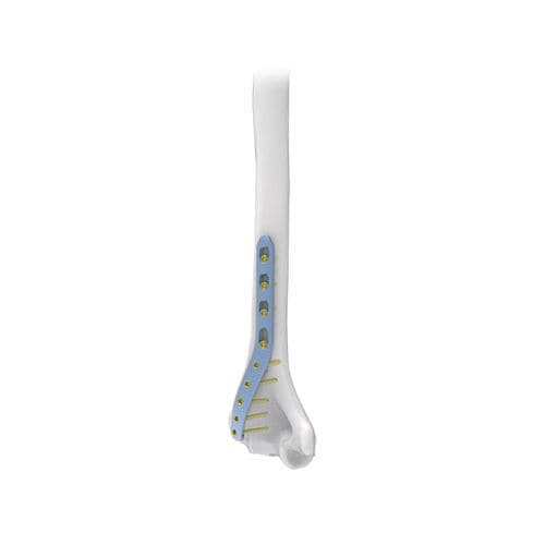 肱骨加压接骨板 - NORMMED Medical Devices - 远侧 / 锁定 / 金属