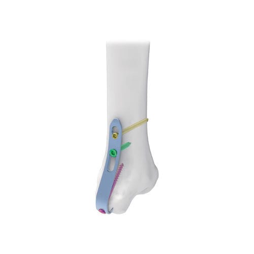 踝部加压接骨板 - NORMMED Medical Devices - 中间 / 锁定 / 金属