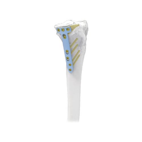 胫骨截骨术固定板 - NORMMED Medical Devices - 锁定 / 金属