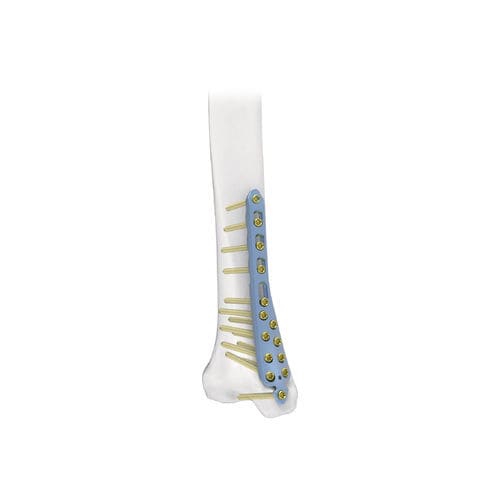 胫骨加压接骨板 - PNM1014 - NORMMED Medical Devices - 远侧 / 中间 / 锁定