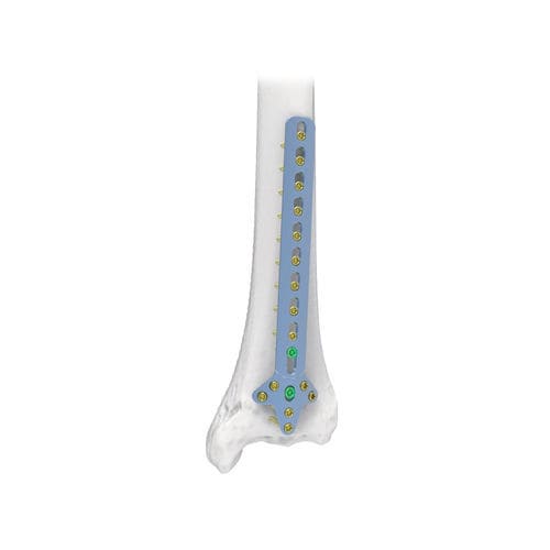 肱骨加压接骨板 - NORMMED Medical Devices - 远侧 / 锁定