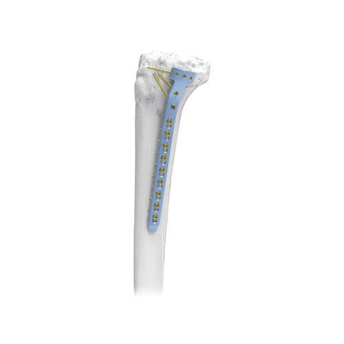胫骨加压接骨板 - PNM1054-TP2 - NORMMED Medical Devices - 近端 / 中间 / 锁定