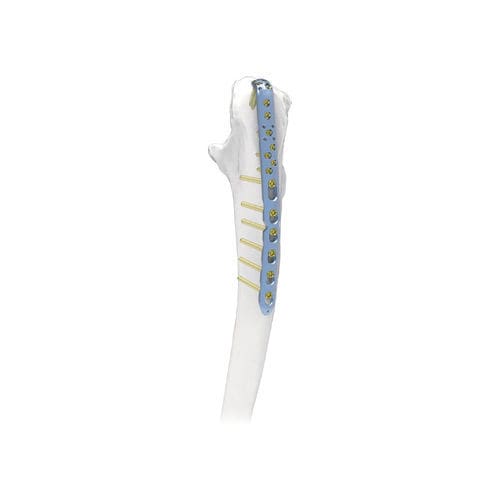 肘突加压接骨板 - PNM1042 - NORMMED Medical Devices - 锁定 / 金属