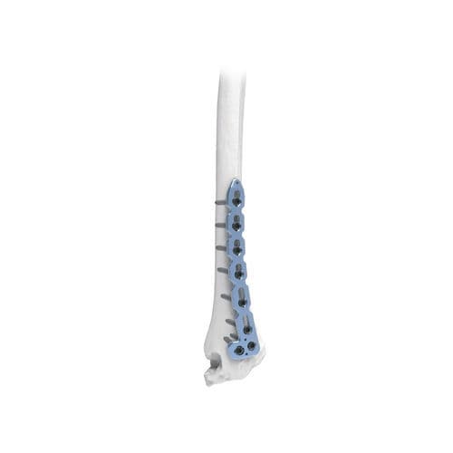 桡骨加压接骨板 - PNM1041 - NORMMED Medical Devices - 远侧 / 背部 / 锁定