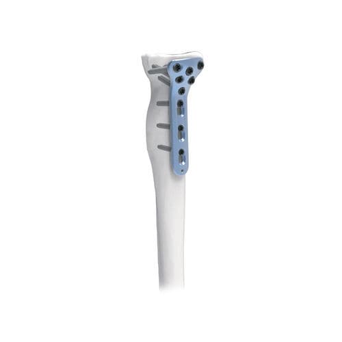 桡骨加压接骨板 - PNM1034 - NORMMED Medical Devices - 近端 / 锁定 / 金属