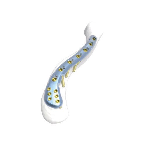 锁骨加压接骨板 - PNM1001 - NORMMED Medical Devices - 远侧 / 锁定 / 金属