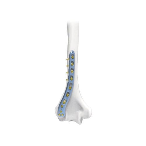 肱骨加压接骨板 - NORMMED Medical Devices - 远侧 / 后外侧 / 锁定
