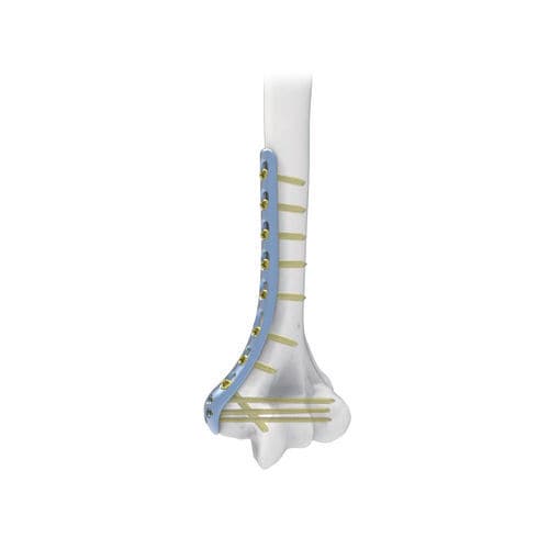 肱骨加压接骨板 - PNM1005 - NORMMED Medical Devices - 远侧 / 中间 / 锁定