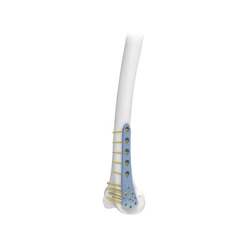 股骨加压接骨板 - PNM1022 - NORMMED Medical Devices - 远侧 / 锁定 / 金属