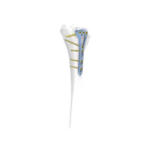 胫骨加压接骨板 - NORMMED Medical Devices - 远侧 / 后外侧 / 锁定