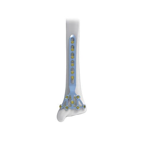 胫骨加压接骨板 - Pilon - NORMMED Medical Devices - 锁定 / 金属