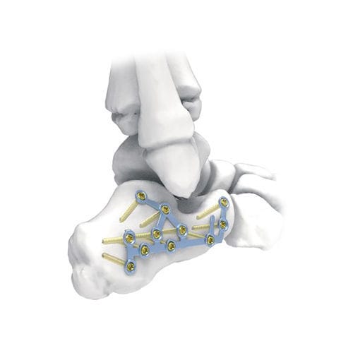 跟骨加压接骨板 - PNM1032 - NORMMED Medical Devices - 锁定 / 金属