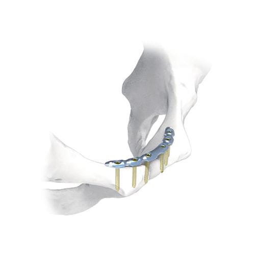 骨盆加压接骨板 - NORMMED Medical Devices - 锁定 / 金属
