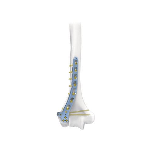 肱骨加压接骨板 - PNM1007 - NORMMED Medical Devices - 远侧 / 后外侧 / 锁定