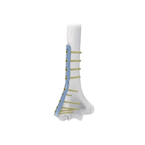 肱骨加压接骨板 - NORMMED Medical Devices - 远侧 / 侧面 / 锁定