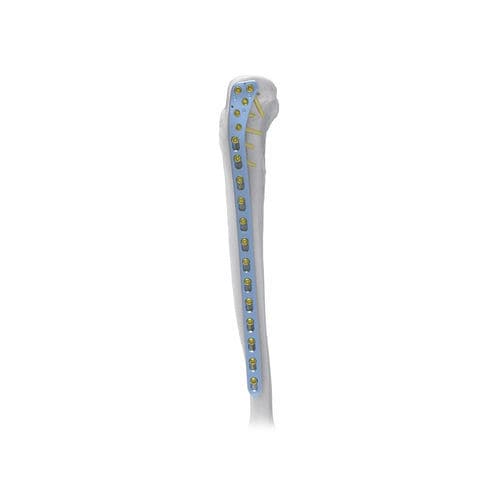 胫骨加压接骨板 - Large  - NORMMED Medical Devices - 近端 / 侧面 / 锁定