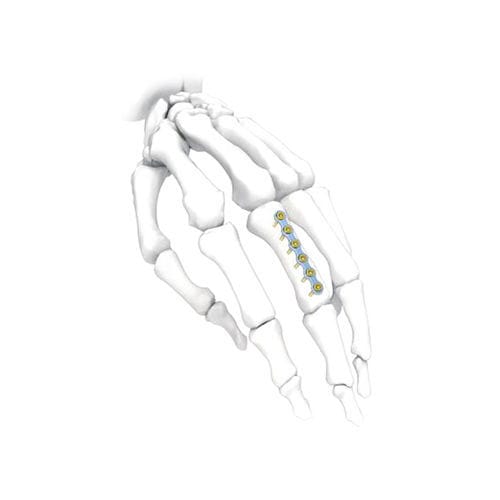 手加压接骨板 - PNM5002 - NORMMED Medical Devices - 锁定 / 金属