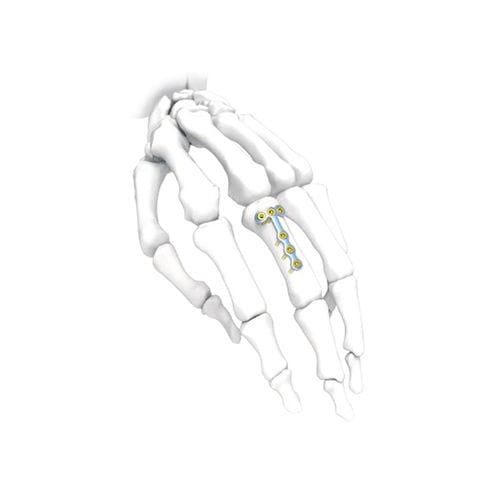 手加压接骨板 - PNM5004 - NORMMED Medical Devices - 锁定 / 金属