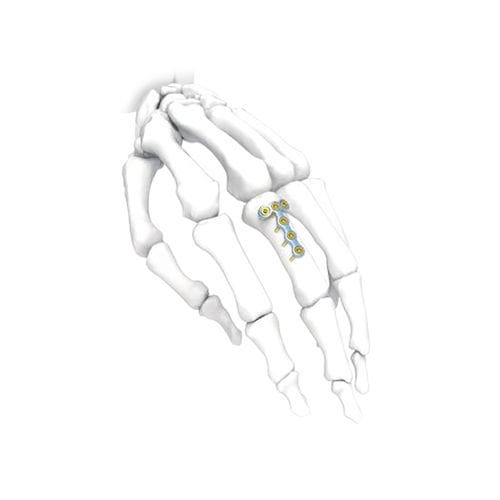 手加压接骨板 - T - NORMMED Medical Devices - 锁定 / 金属