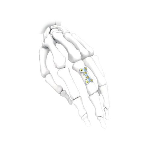 手加压接骨板 - PNM5006-022 - NORMMED Medical Devices - 锁定 / 金属