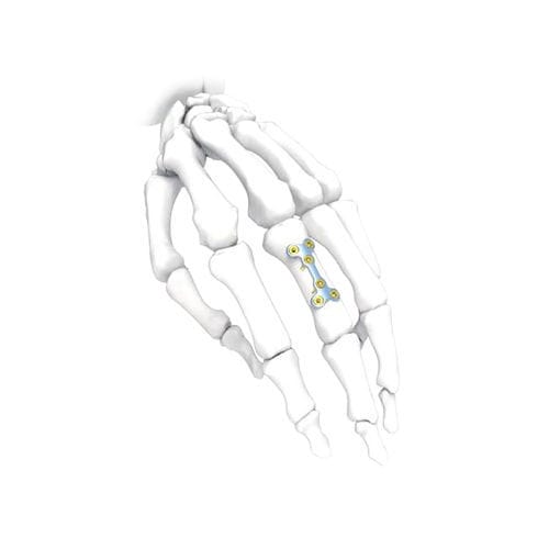 手加压接骨板 - PNM5006-032 - NORMMED Medical Devices - 锁定 / 金属