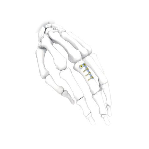 手加压接骨板 - L  - NORMMED Medical Devices - 锁定 / 金属