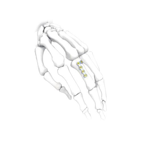 手加压接骨板 - NORMMED Medical Devices - 锁定 / 金属