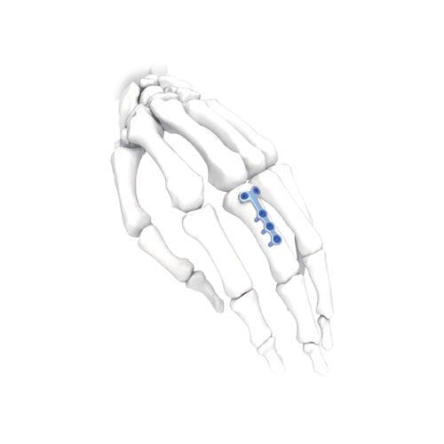 手加压接骨板 - T - NORMMED Medical Devices - 脚 / 锁定 / 金属