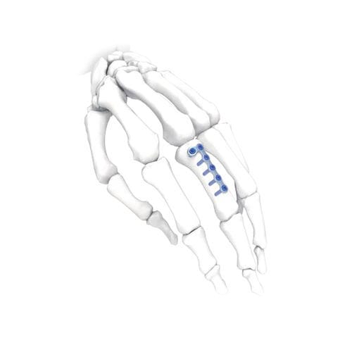 手加压接骨板 - L - NORMMED Medical Devices - 脚 / 锁定 / 金属