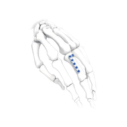 手加压接骨板 - PNM5012-100 - NORMMED Medical Devices - 脚 / 锁定 / 金属