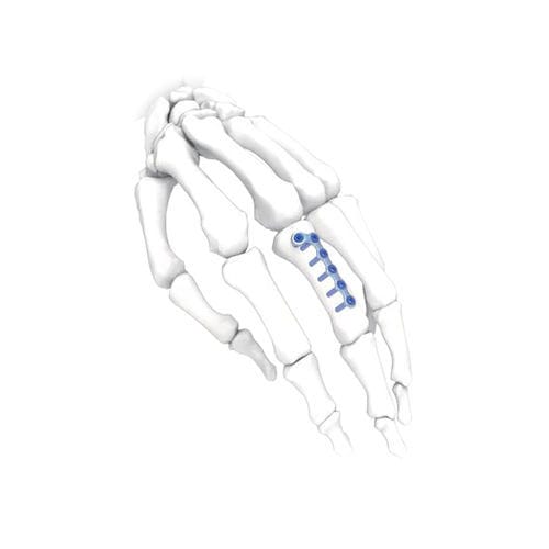 手加压接骨板 - L Oblique  - NORMMED Medical Devices - 脚 / 锁定 / 金属