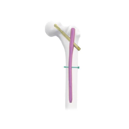 股骨髓内钉 - NORMMED Medical Devices - 股骨转子 / 金属