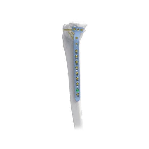 胫骨加压接骨板 - NORMMED Medical Devices - 近端 / 中间 / 锁定
