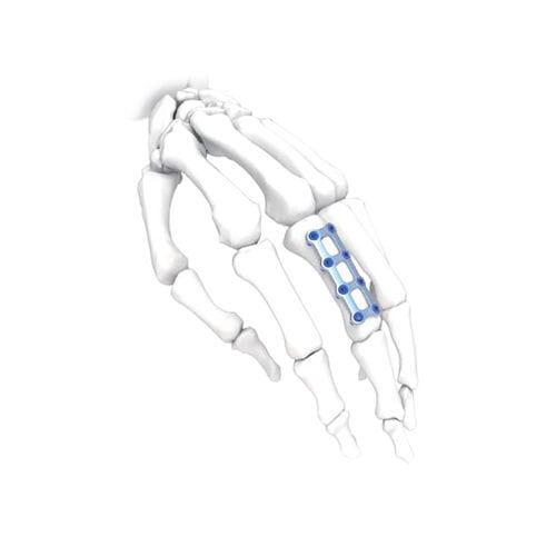 手加压接骨板 - Mini  - NORMMED Medical Devices - 锁定 / 金属