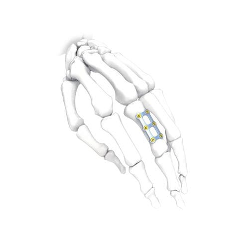 手加压接骨板 - H Short - NORMMED Medical Devices - 脚 / 锁定 / 金属
