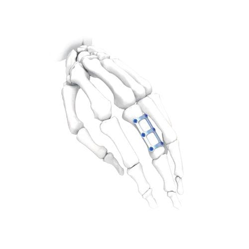 手加压接骨板 - H Long - NORMMED Medical Devices - 脚 / 锁定 / 金属