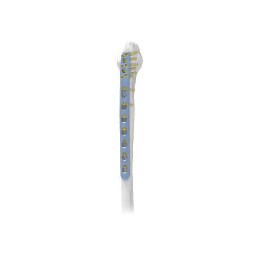 腓骨加压接骨板 - PNM1017 - NORMMED Medical Devices - 远侧 / 后外侧 / 锁定