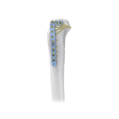 胫骨加压接骨板 - NORMMED Medical Devices - 近端 / 侧面 / 锁定