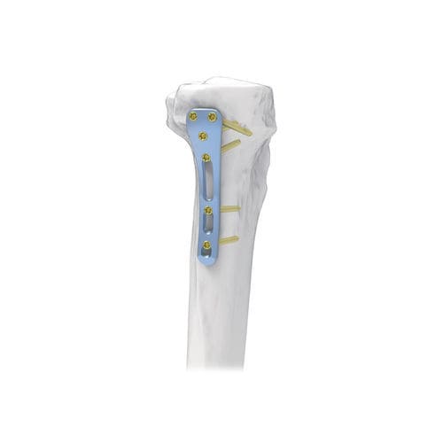 胫骨加压接骨板 - NORMMED Medical Devices - 近端 / 后内侧 / 锁定