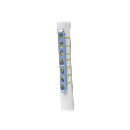 小骨碎片加压接骨板 - NORMMED Medical Devices - 锁定 / 金属