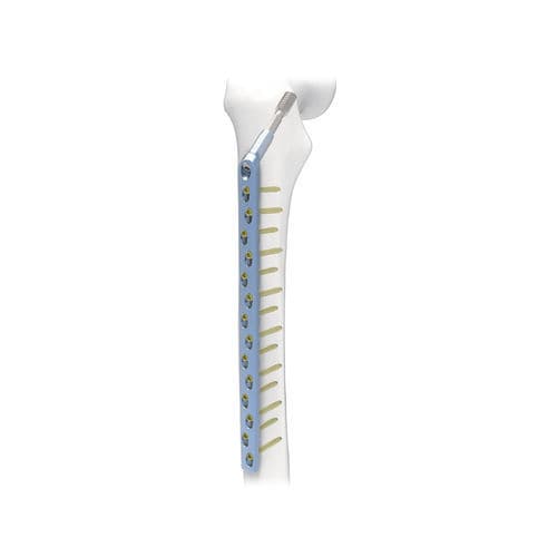 股骨加压接骨板 - PNM1024 - NORMMED Medical Devices - 锁定 / 金属