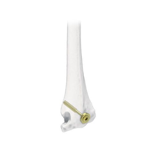 肱骨加压接骨螺钉 - NORMMED Medical Devices - 引流管 / 金属