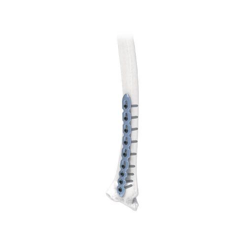 桡骨加压接骨螺钉 - NORMMED Medical Devices - 金属