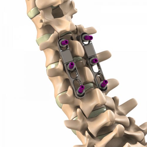 胸腰椎脊柱内固定系统 - Ti-6Al-4V ELI  - Aditus Medical - 后入路