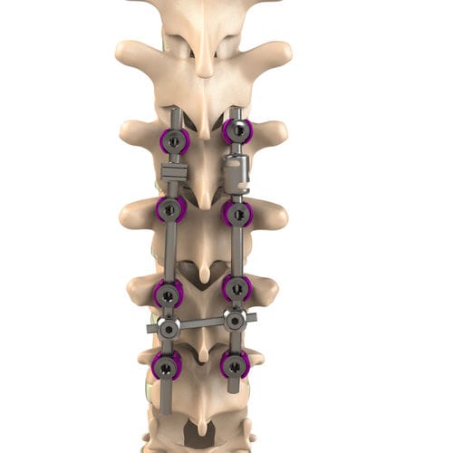 胸腰椎脊柱内固定系统 - Aditus Medical - 后入路