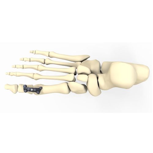 拇指外翻关节固定板 - FRC20 series - Aleda Medical - 锁定 / 金属