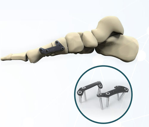 拇指外翻关节固定板 - FRC200 series - Aleda Medical - 锁定 / 金属