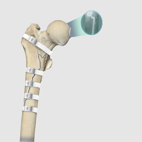 髋关节翻修手术骨科环扎线 - Ortholox® UHMWPE - Ortolog Medikal - 聚合物复丝