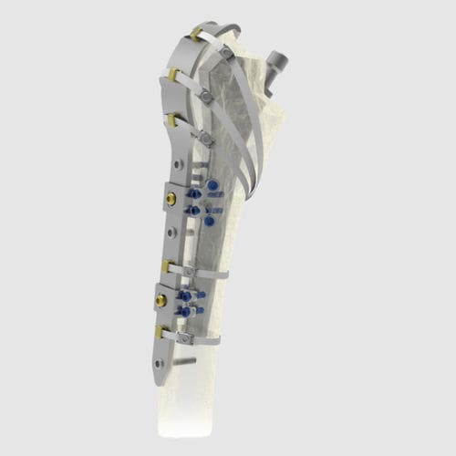 股骨假体周围骨折加压接骨板 - Ortholox®  - Ortolog Medikal - 近端 / 锁定 / 钛