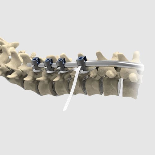 儿科脊柱后路固定带 - Ortholox&reg; UHMWPE - Ortolog Medikal